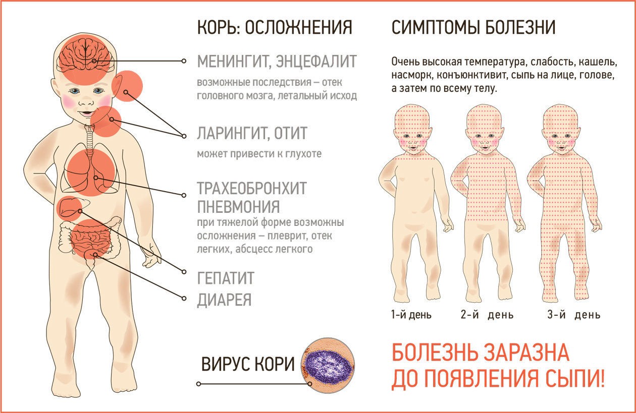 «Вероятность заразиться — 100%»: в регионах России — вспышки кори..